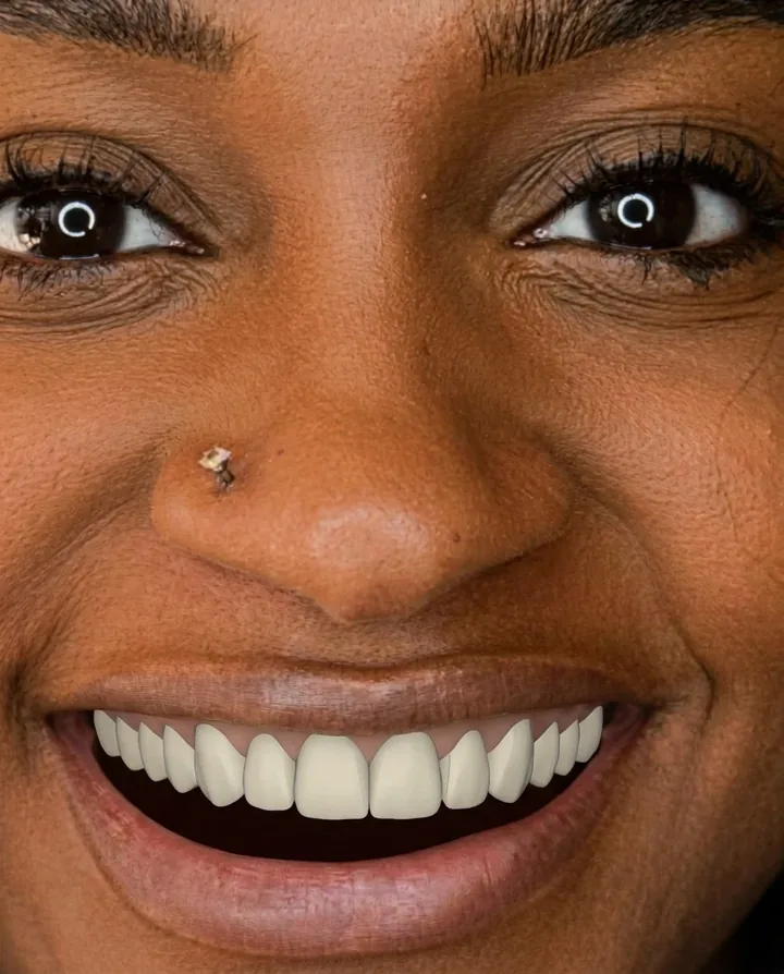 Digital dental mockup fitted to the patient's smile