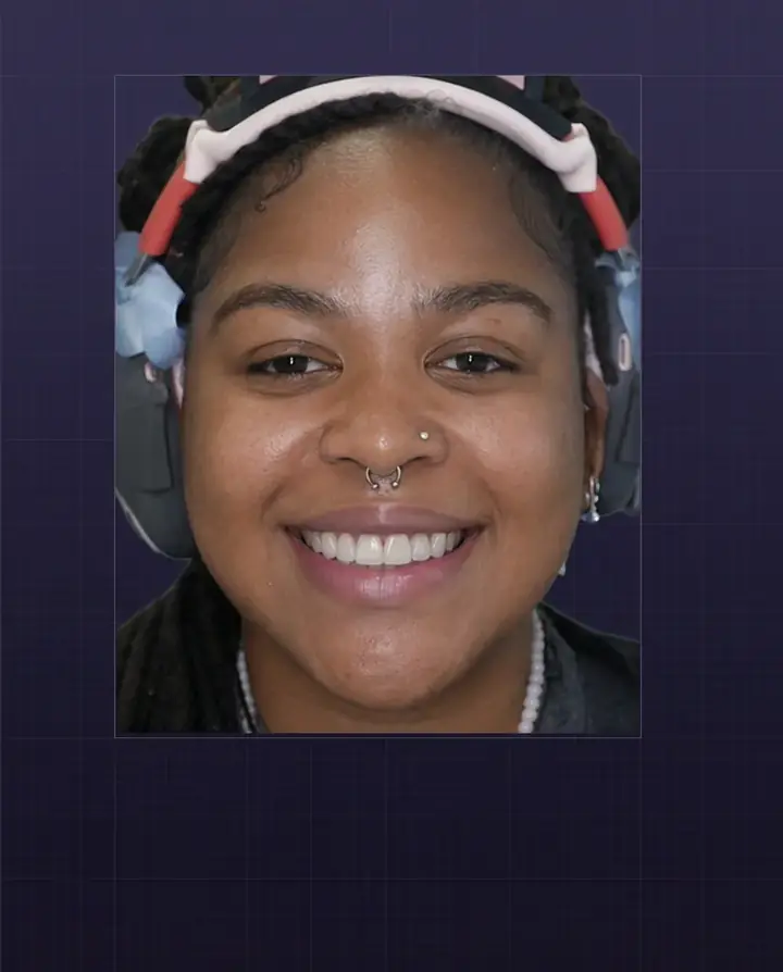 Slim white three-dimensional dental design fitted to the patient's smile